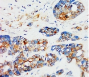IHC-P: Alpha Tubulin antibody testing of human breast cancer tissue.