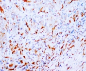 IHC-P: beta-Tubulin antibody testing of human breast cancer tissue