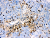 IHC testing of FFPE human lung cancer tissue with beta-Actin antibody. HIER: Boil the paraffin sections in pH 6, 10mM citrate buffer for 20 minutes and allow to cool prior to testing.