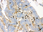 IHC testing of FFPE human intestinal cancer tissue with beta-Actin antibody. HIER: Boil the paraffin sections in pH 6, 10mM citrate buffer for 20 minutes and allow to cool prior to testing.