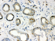 IHC testing of FFPE human breast cancer tissue with beta-Actin antibody. HIER: Boil the paraffin sections in pH 6, 10mM citrate buffer for 20 minutes and allow to cool prior to testing.