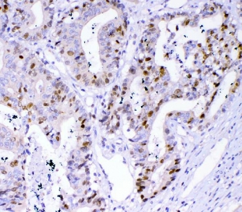 IHC staining of FFPE human colon cancer tissue with Survivin antibody. HIER: boil tissue sections in pH8 EDTA for 20 min and allow to cool before testing.~