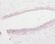 IHC staining of FFPE human breast cancer with Angiostatin K1-3 antibody. HIER: boil tissue sections in pH6, 10mM citrate buffer, for 20 min and allow to cool before testing.