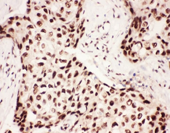 IHC-P: 5-Lipoxygenase antibody testing of human breast cancer tissue