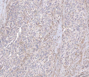 Immunohistochemical staining of FFPE human bladder cancer tissue with ANG2 antibody, HRP-secondary and DAB substrate. HIER: boil tissue sections in pH8 EDTA for 20 min and allow to cool before testing.