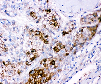IHC staining of FFPE human liver cancer tissue with CBS antibody. HIER: boil tissue sections in pH8 EDTA for 20 min and allow to cool before testing.~