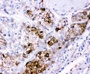 IHC staining of FFPE human liver cancer tissue with CBS antibody. HIER: boil tissue sections in pH8 EDTA for 20 min and allow to cool before testing.
