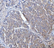 IHC staining of FFPE human cervical cancer tissue with Dicer antibody. HIER: boil tissue sections in pH8 EDTA for 20 min and allow to cool before testing.