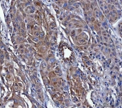 IHC staining of FFPE human penis squamous cell carcinoma tissue with Dicer antibody. HIER: boil tissue sections in pH8 EDTA for 20 min and allow to cool before testing.