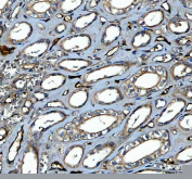 Immunohistochemical staining of FFPE human prostate cancer tissue with PKC delta antibody, HRP-secondary and DAB substrate. HIER: boil tissue sections in pH8 EDTA for 20 min and allow to cool before testing.