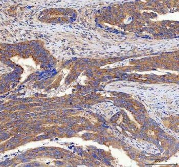 IHC staining of FFPE human lung cancer with SSH3BP1 antibody. HIER: boil tissue sections in pH6, 10mM citrate buffer, for 20 min and allow to cool before testing.