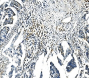 IHC staining of FFPE human ovarian cancer tissue with Bax antibody. HIER: boil tissue sections in pH8 EDTA for 20 min and allow to cool before testing.