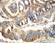 IHC-P: Calretinin antibody testing of human rectal cancer tissue. HIER: steamed with pH6 citrate buffer.