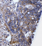 IHC staining of FFPE human rectal cancer tissue with CD44 antibody. HIER: boil tissue sections in pH8 EDTA for 20 min and allow to cool before testing.