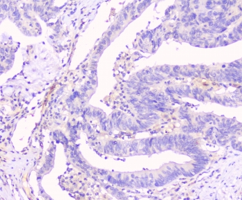 IHC testing of human intestinal cancer tissue with Cx43 antibody at 1ug/ml. HIER: steam section in pH6 citrate buffer for 20 min and allow to cool prior to staining.