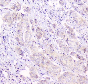 IHC testing of human breast cancer tissue with Cx43 antibody at 1ug/ml. HIER: steam section in pH6 citrate buffer for 20 min and allow to cool prior to staining.