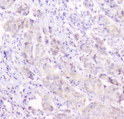 IHC testing of human breast cancer tissue with Cx43 antibody at 1ug/ml. HIER: steam section in pH6 citrate buffer for 20 min and allow to cool prior to staining.
