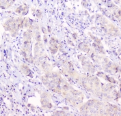 IHC testing of human breast cancer tissue with Cx43 antibody at 1ug/ml. HIER: steam section in pH6 citrate buffer for 20 min and allow to cool prior to staining.