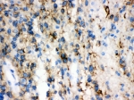 IHC-P: GAP43 antibody testing of human glioma tissue. HIER: steamed with pH6 citrate buffer.