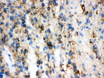 IHC-P: GAP43 antibody testing of human glioma tissue