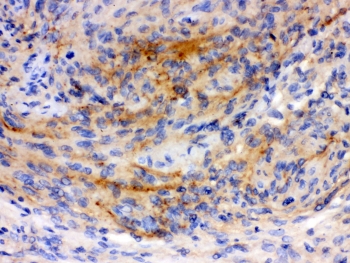 IHC-P: GAP43 antibody testing of human Menginges tumor tissue