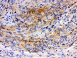 IHC-P: GAP43 antibody testing of human Menginges tumor tissue. HIER: steamed with pH6 citrate buffer.