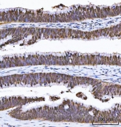 IHC staining of FFPE moderately differentiated highly differentiated human adenocarcinoma of the colon tissue with GST pi antibody. HIER: boil tissue sections in pH8 EDTA for 20 min and allow to cool before testing.