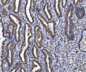 IHC staining of FFPE moderately differentiated human adenocarcinoma of the cervical canal tissue with GST pi antibody. HIER: boil tissue sections in pH8 EDTA for 20 min and allow to cool before testing.