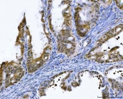 IHC staining of FFPE human ovarian cancer tissue with GST pi antibody. HIER: boil tissue sections in pH8 EDTA for 20 min and allow to cool before testing.