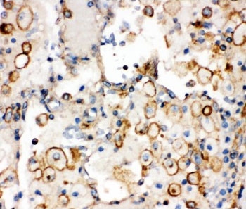 IHC-P: Integrin alpha 1 antibody testing of human lung cancer tissue