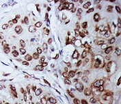 IHC staining of FFPE human breast cancer tissue with Lamin B1 antibody. HIER: boil tissue sections in pH8 EDTA for 20 min and allow to cool before testing.
