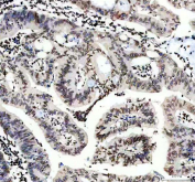 IHC staining of FFPE human breast cancer tissue with Lamin B1 antibody. HIER: boil tissue sections in pH8 EDTA for 20 min and allow to cool before testing.