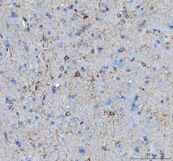 IHC staining of FFPE human breast cancer with c-Kit antibody. HIER: boil tissue sections in pH6 citrate buffer for 20 min and allow to cool before testing.