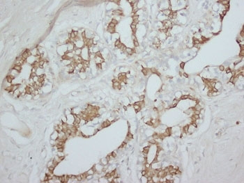 IHC staining of FFPE human breast cancer tissue with PKC alpha antibody. HIER: boil tissue sections in pH8 EDTA for 20 min and allow to cool before testing.~