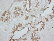 IHC staining of FFPE human breast cancer tissue with PKC alpha antibody. HIER: boil tissue sections in pH8 EDTA for 20 min and allow to cool before testing.