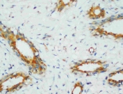IHC staining of FFPE human breast cancer with PP2Ac antibody. HIER: boil tissue sections in pH8 EDTA buffer for 20 min and allow to cool before testing.