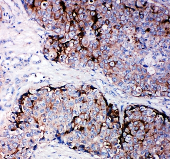 IHC-P: TIMP2 antibody testing of human breast cancer tissue