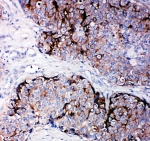 IHC-P: TIMP2 antibody testing of human breast cancer tissue. HIER: steamed with pH6 citrate buffer.