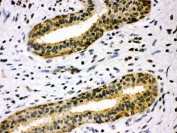 IHC-P testing of TIMP4 antibody and human breast cancer tissue. HIER: steamed with pH6 citrate buffer.