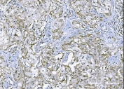 IHC staining of FFPE human B lymphocytic tumor tissue with TNF alpha antibody. HIER: boil tissue sections in pH8 EDTA for 20 min and allow to cool before testing.