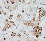 IHC-P: SKP2 antibody testing of human breast cancer tissue