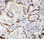 IHC-P: Lamin A/C antibody testing of human lung cancer tissue