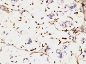 IHC-P: IFITM1 antibody testing of human intestinal cancer tissue