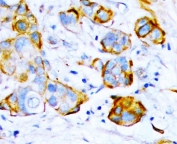 IHC-P: SHP2 antibody staining of human thyroid cancer tissue.