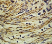 IHC staining of FFPE human rectal cancer tissue with MMP16 antibody. HIER: boil tissue sections in pH6 citrate buffer for 20 min and allow to cool before testing.