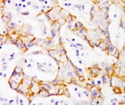 IHC-P: beta Catenin antibody testing of human breast cancer tissue