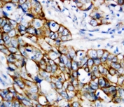 IHC-P: b-Catenin antibody testing of human breast cancer tissue