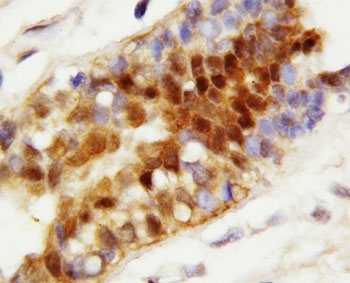 IHC-P: HSC70 antibody testing of human breast cancer tissue. HIER: boil tissue sections in pH6, 10mM citrate buffer, for 20 min and allow to cool before testing.