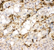 IHC-P: FABP1 antibody testing of human liver cancer tissue. HIER: steamed with pH6 citrate buffer.