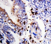 IHC-P: Bcl-XS antibody testing of human colon cancer tissue. HIER: steamed with pH6 citrate buffer.